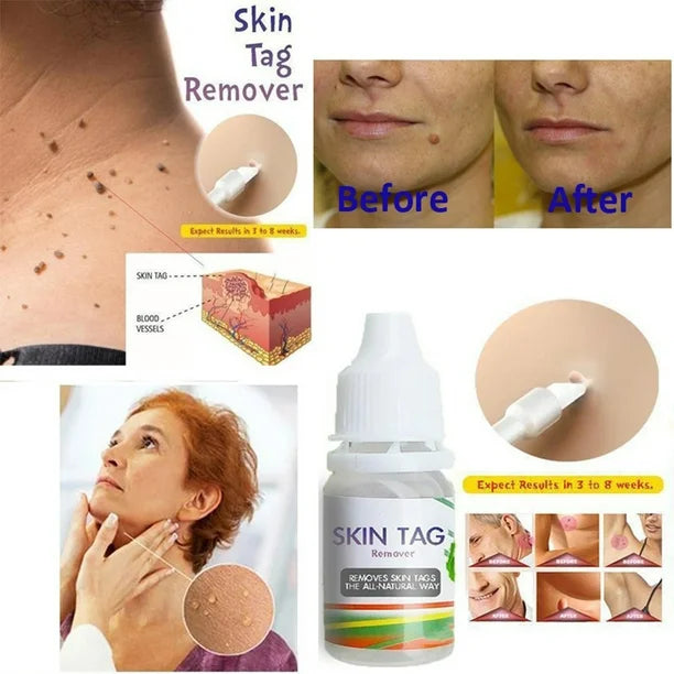 REMOVEDOR DE VERRUGAS Y LUNARES - SKIN TAG GOTA